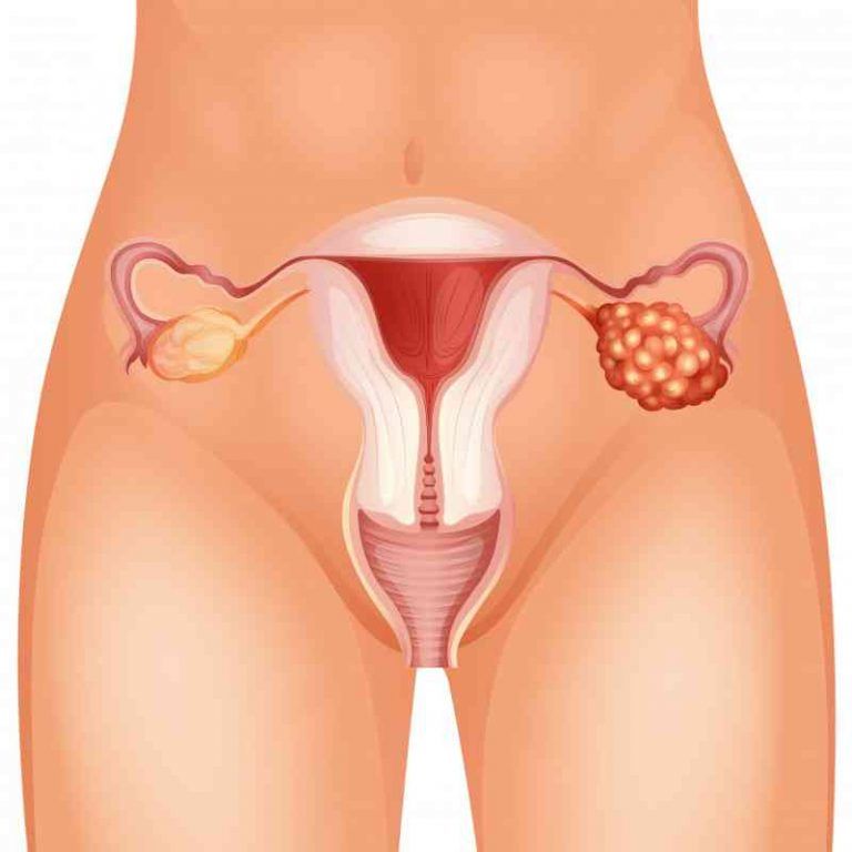 Her Kadının Bilmesi Gereken Yumurtalık Kanserinin 4 Erken Semptomu 2 2 8