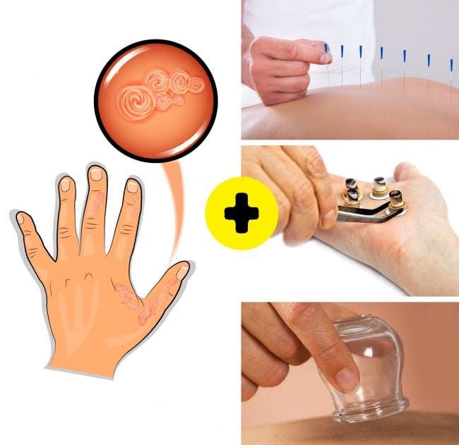 Bir Çok Hastalıktan Kurtaran Hacamatın Faydaları 13 hacamat cilt hastalıklarına iyi gelir mi