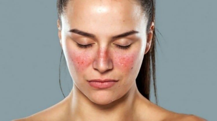 Kelebek (Lupus) Hastalığıyla İlgili Bilmeniz Gereken 13 Erken Belirti 3 2 5