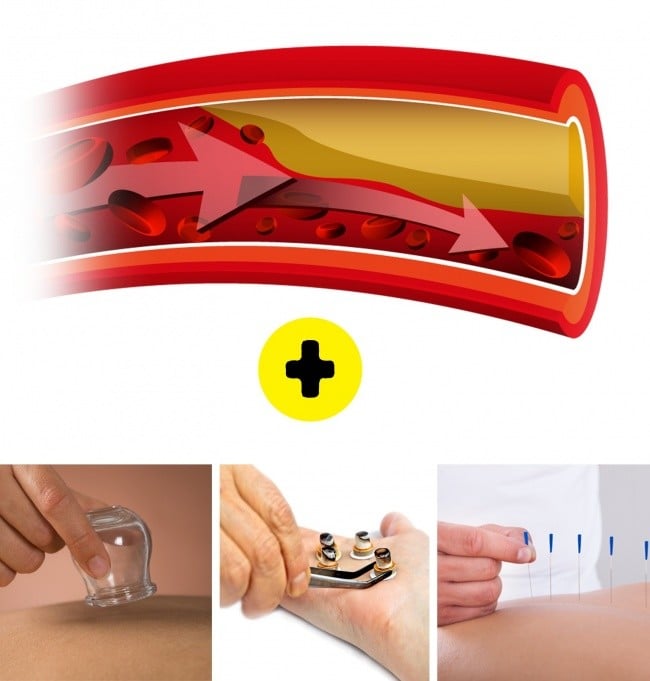 Bir Çok Hastalıktan Kurtaran Hacamatın Faydaları 7 hacamat kan basıncına iyi gelir mi