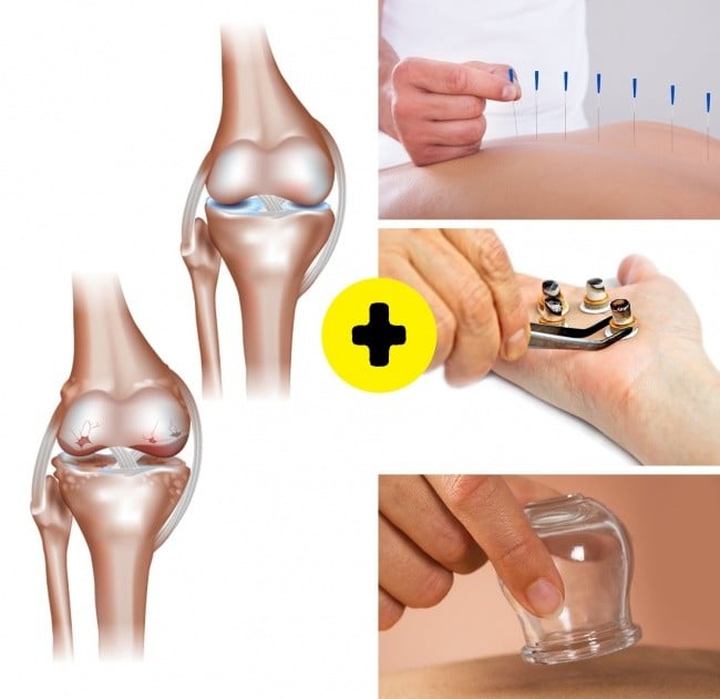 Bir Çok Hastalıktan Kurtaran Hacamatın Faydaları 9 hacamat kireçlenmeye iyi gelir mi