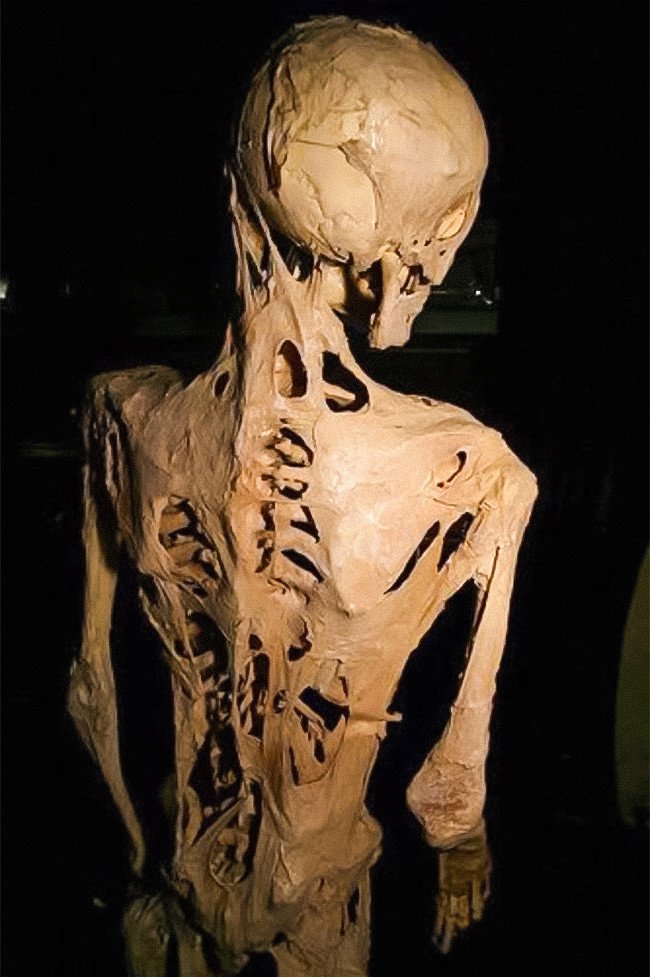 Doktorların Hakkında Hiçbir Şey Bilmediği 12 Tuhaf Hastalık ve Sendrom 2 Fibrodisplazi