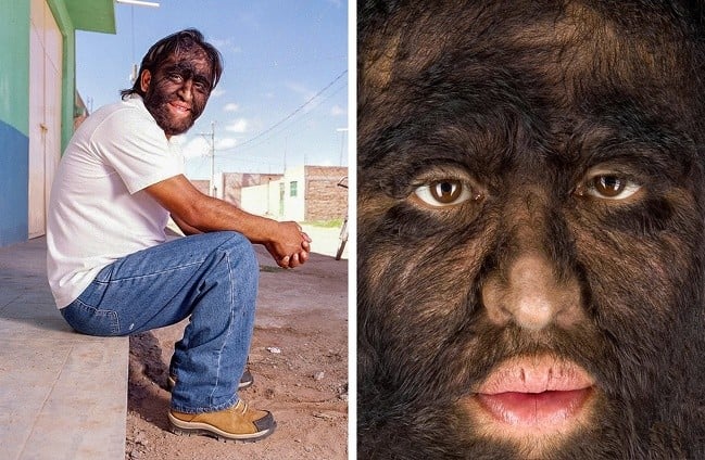 Doktorların Hakkında Hiçbir Şey Bilmediği 12 Tuhaf Hastalık ve Sendrom 8 Hipertrikoz