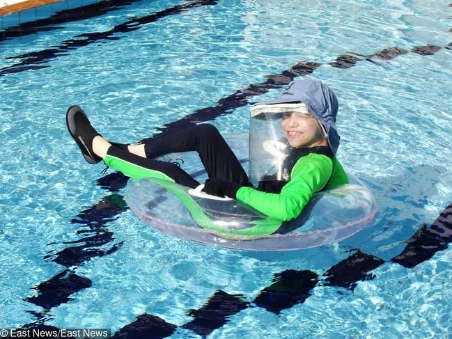 Doktorların Hakkında Hiçbir Şey Bilmediği 12 Tuhaf Hastalık ve Sendrom 6 Kseroderma