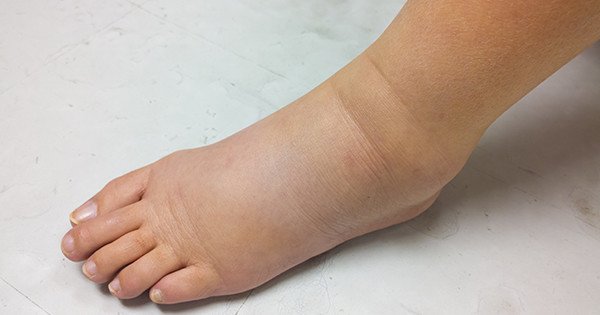 ayak şişmesi