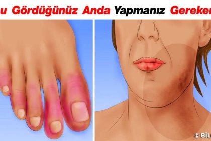 Kelebek (Lupus) Hastalığıyla İlgili Bilmeniz Gereken 13 Erken Belirti 4 kelebek hastaligiyla ilgili bilmeniz gereken 13 erken belirti ve gordugunuz anda yapmaniz gerekenler