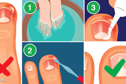 tırnak batmasından ameliyat olmadan kurtulun