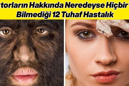 Doktorların Hakkında Hiçbir Şey Bilmediği 12 Tuhaf Hastalık ve Sendrom 20 tuhaf hastaliklar