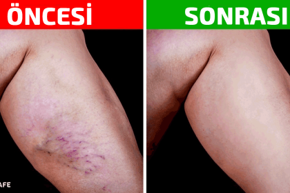varisli damarlardan kurtulmak için evde uygulanabilecek 8 yöntem