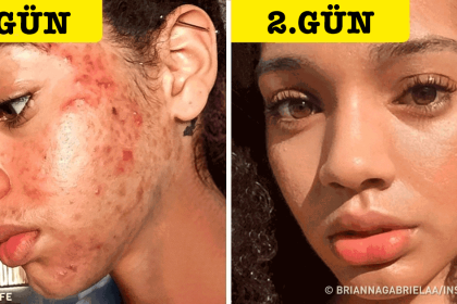 bu yöntemle 30 günde sivilcelerden kurtulan kadın