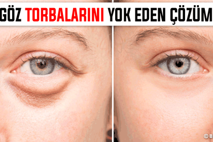 Göz Altı Torbalarına Ne İyi Gelir ve Nasıl Geçer En Hızlı Doğal Çözüm 20 göz torbaları