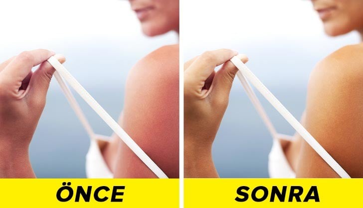 Limon Suyu ile Sağlık ve Güzellik Konusunda 9 Önemli İpucu 8 gunes yanigi