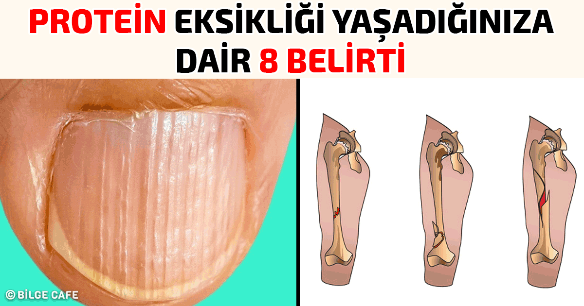 Protein Eksikliği Yaşadığınıza Dair 8 Belirti 16 protein eksikliği belirtileri