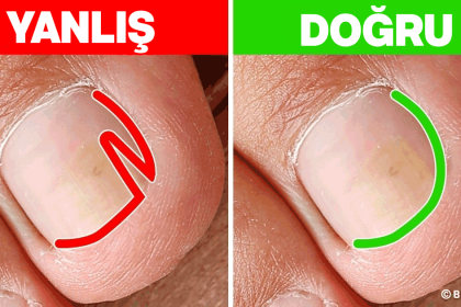 tırnak batmasına ne iyi gelir