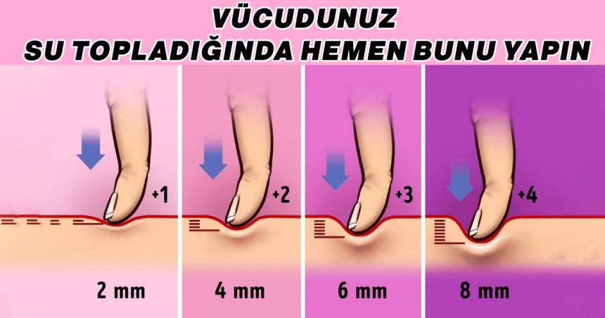 Su Toplama Nasıl Tedavi Edilir? Bir Daha Çıkmaması İçin Hangi Önlemleri Almalıyız ? 1 vucut