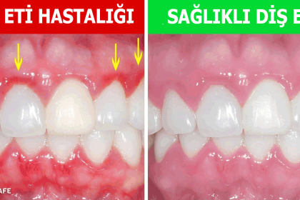 dişlerimize ve diş etlerimize zarar veren alışkanlıklar