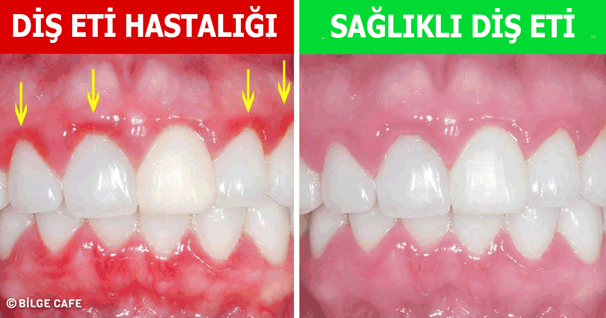 Dişlerimize ve Diş Etlerimize Zarar Veren 7 Kötü Alışkanlık! 16 dişlerimize ve diş etlerimize zarar veren alışkanlıklar