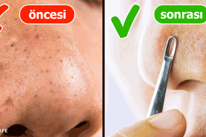 siyah noktaları önlemek