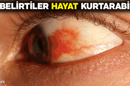 yüksek tansiyon belirtileri