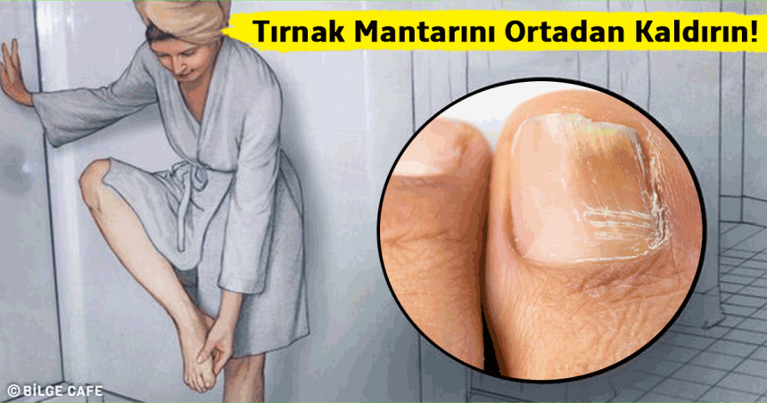 Tırnak Mantarını Ortadan Kaldıran Mucize Çözüm 1 tırnak mantarını ortadan kaldırın