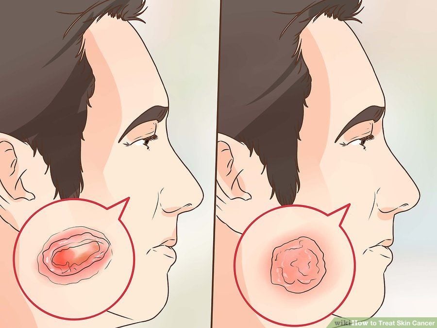 Benler ve Güneş Yanıkları ile İlgili Doğru Bilinen Yanlışlar 10 1 5