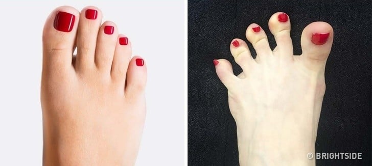 ayak şekil bozukluğu