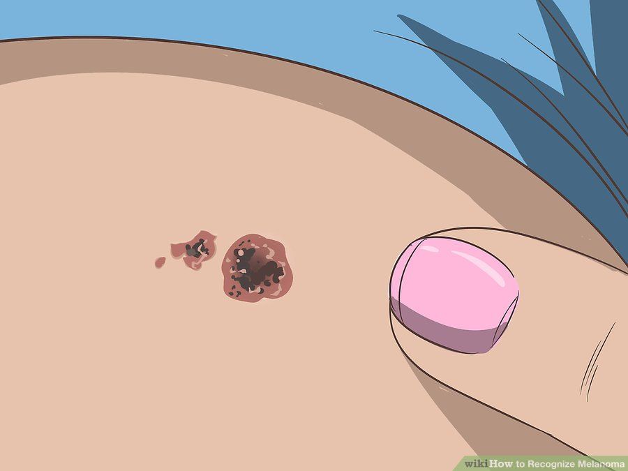 Benler ve Güneş Yanıkları ile İlgili Doğru Bilinen Yanlışlar 4 ben 1