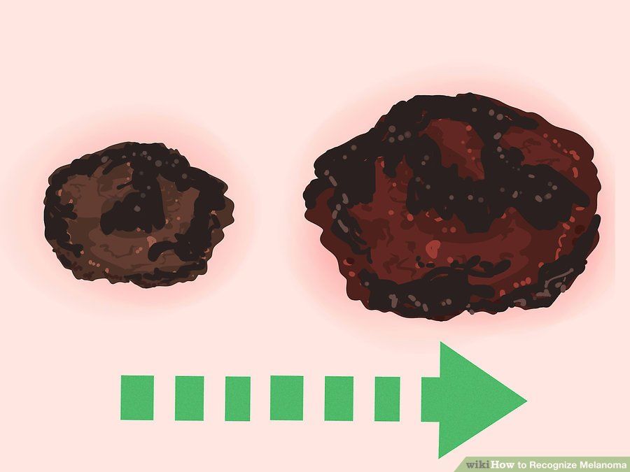 Benler ve Güneş Yanıkları ile İlgili Doğru Bilinen Yanlışlar 3 büyüyen ben