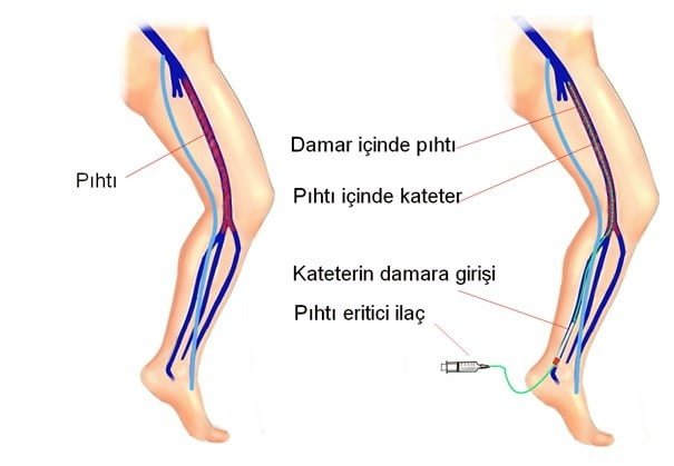 derin ven trombozu 3