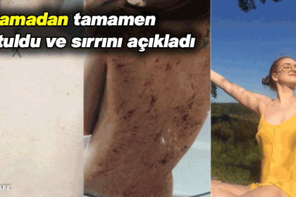 Egzamadan Tamamen Kurtuldu ve Sırrını Açıkladı 16 egzama