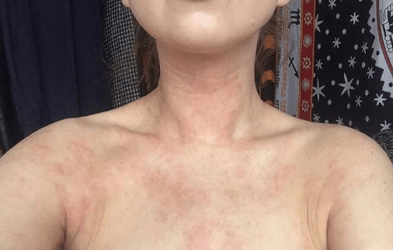 Egzamadan Tamamen Kurtuldu ve Sırrını Açıkladı 6 egzemalı göğüs