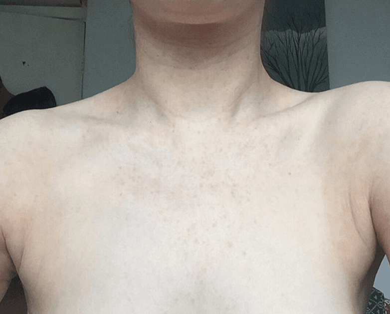 Egzamadan Tamamen Kurtuldu ve Sırrını Açıkladı 7 iyileşmiş göğüs