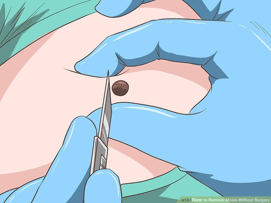 Benler ve Güneş Yanıkları ile İlgili Doğru Bilinen Yanlışlar 5 neşter 2