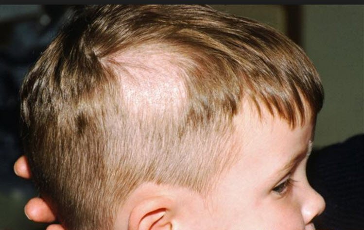 Saçkırana Ne İyi Gelir? Hemen Nasıl Geçer? 4 saçkırana ne iyi gelir