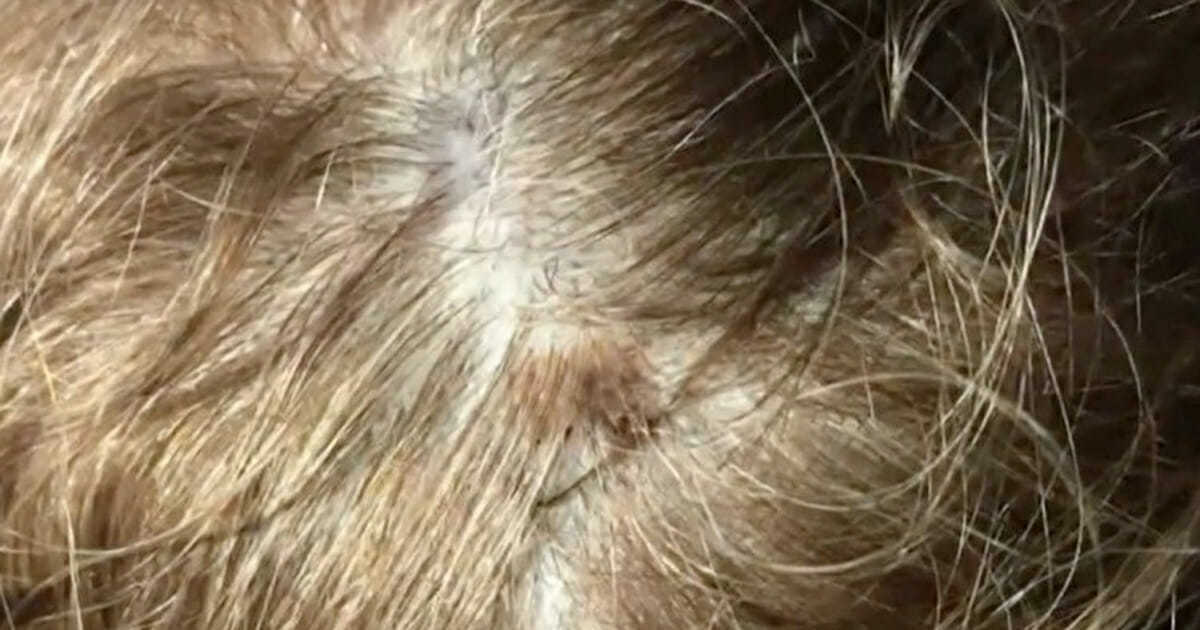 Müşterisinin Saç Derisine Dikkatlice Bakan Kuaför, Kadının Hayatını Kurtardı 3 saç 2