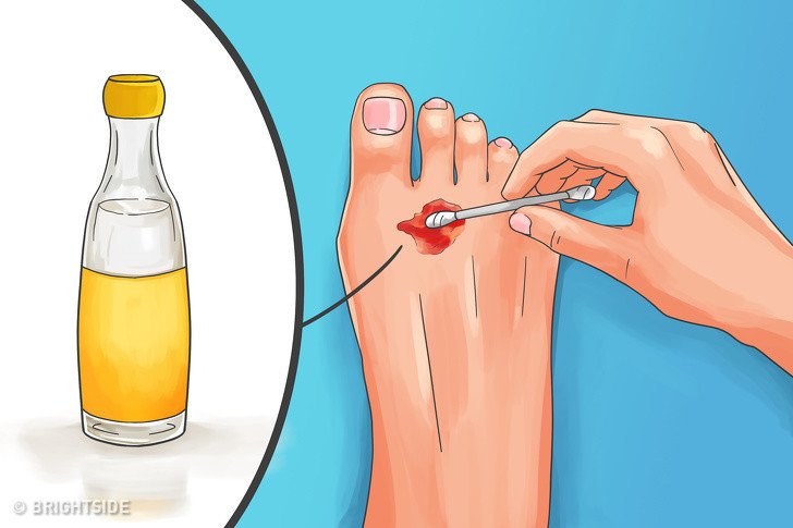 sirke ile yara tedavisi