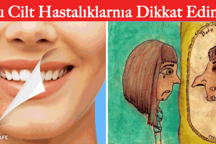 tuhaf cilt hastalıkları