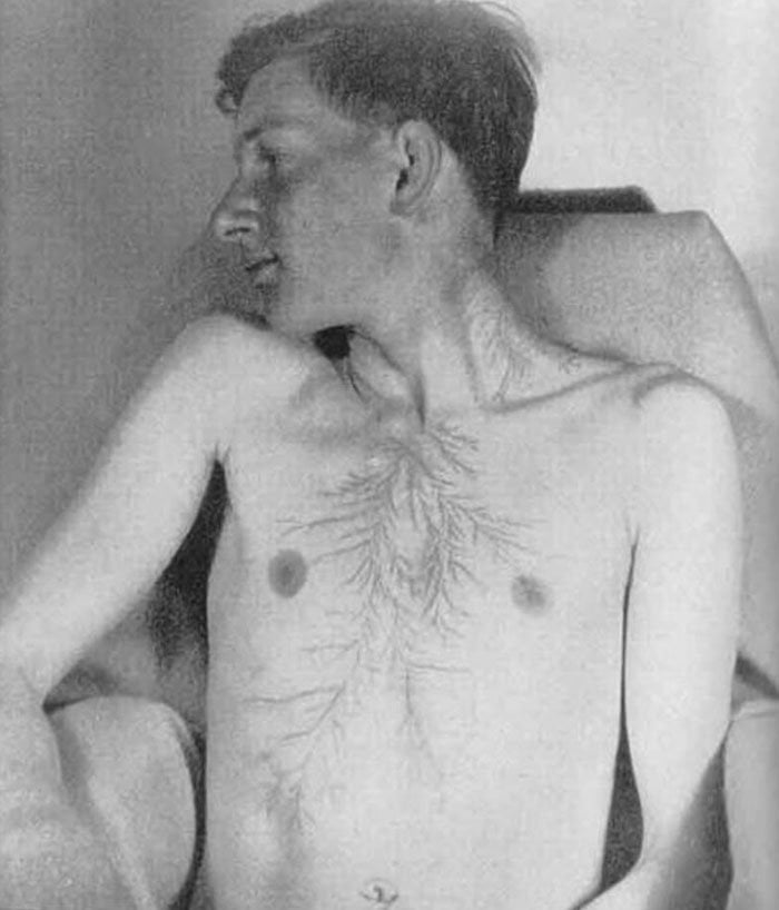 Yıldırım Çarpmasından Canlı Kurtulan İnsanların Vücutlarındaki İzler 7 6