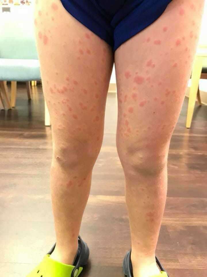 döküntülü bacaklar