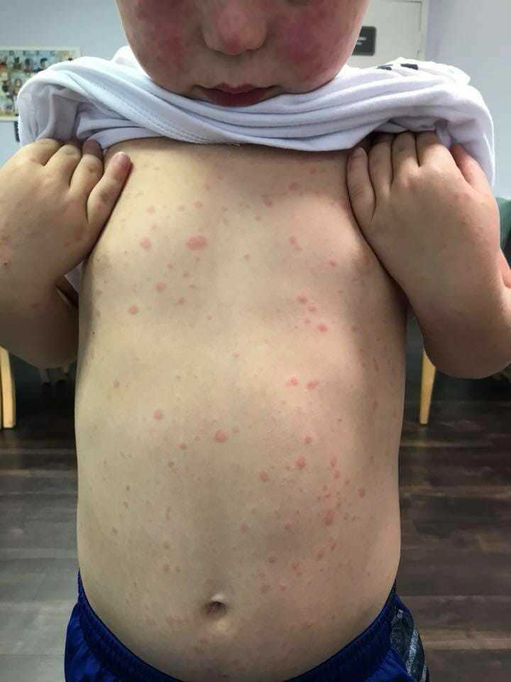 döküntülü üst vücut