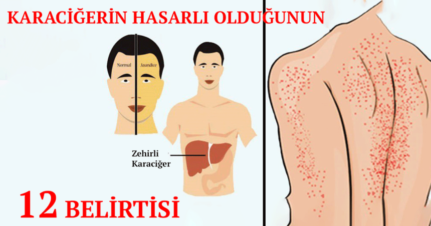 Karaciğerin Hasar Gördüğüne Dair Vücutta Ortaya Çıkan 12 Belirti 22 karaciger