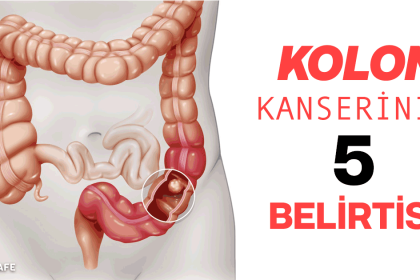 kolon kanseri belirtileri