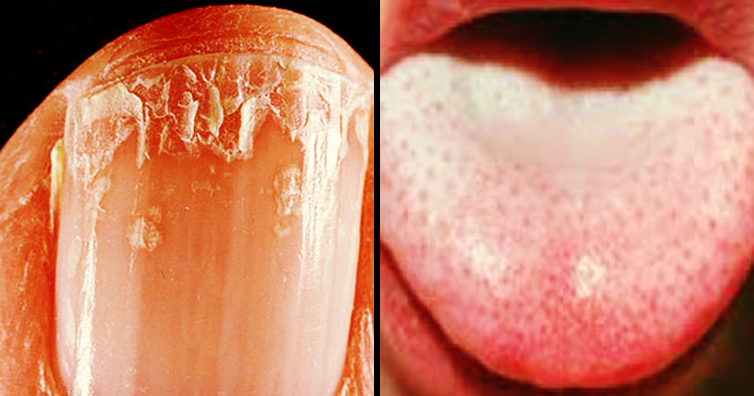 Bu Belirtiler Kanserin İşareti 2 kırılgan tırnak ve dilde beyaz nokta