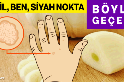 siğil ben siyah nokta