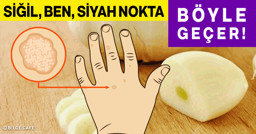 Siğil, Ben, Siyah Nokta ve Yaşlılık Lekeleri Nasıl Ortadan Kaldırılır? 26 siğil ben siyah nokta