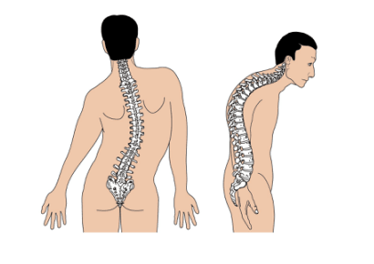 Kas Bozulmasının 8 Erken Belirtisini Görmezden Gelmeyin 4 skolyoz