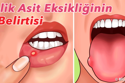 folik asit eksikligi