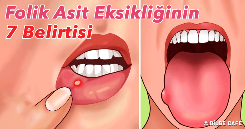 folik asit eksikligi