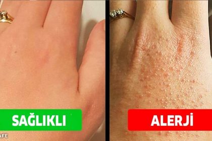 çaktırmadan alerji yapan sebepler