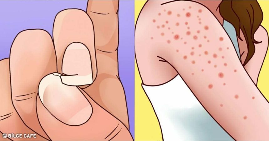 Gluten Hassasiyetinin 9 Belirtisi ve Tedavisi 40 gluten hassasiyeti belirtileri
